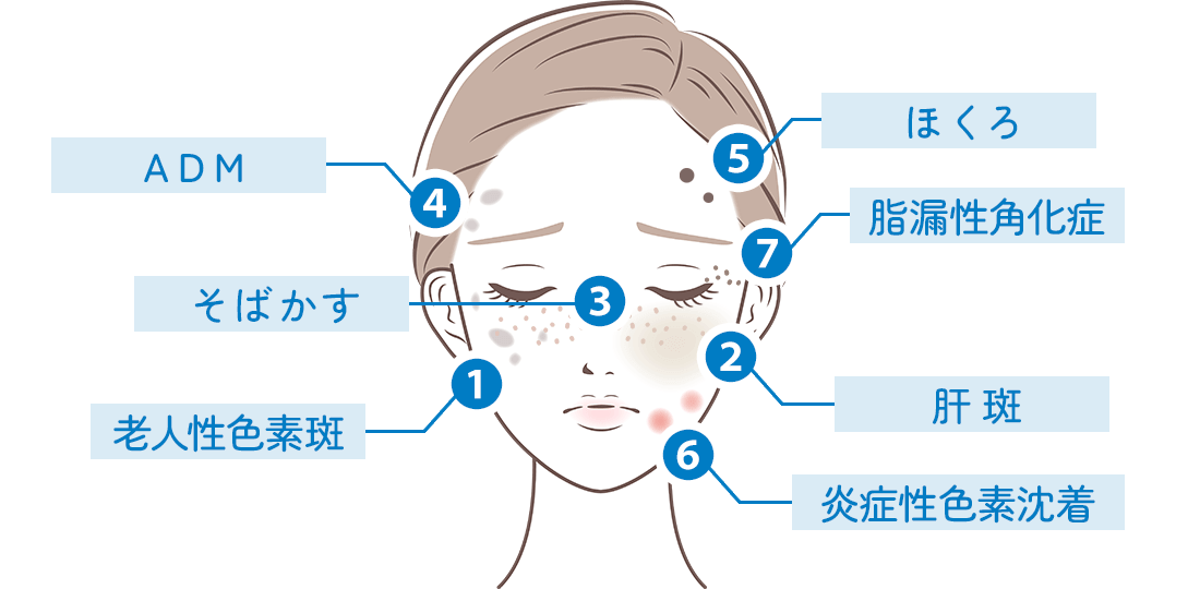 シミの種類イメージ画像